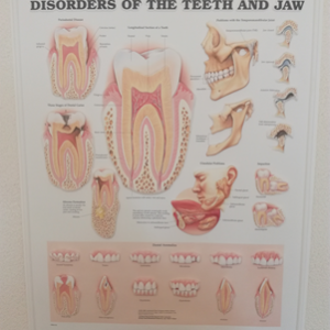 3D Reliëf Poster Aandoeningen aan Gebit en Kaak