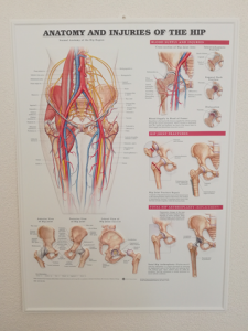 3D Reliëf Poster Anatomie en Blessures van de Heup