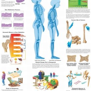 Osteoporosis, papieren wandplaat