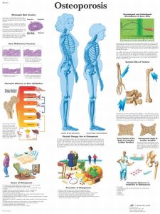 Osteoporosis, gelamineerde wandplaat