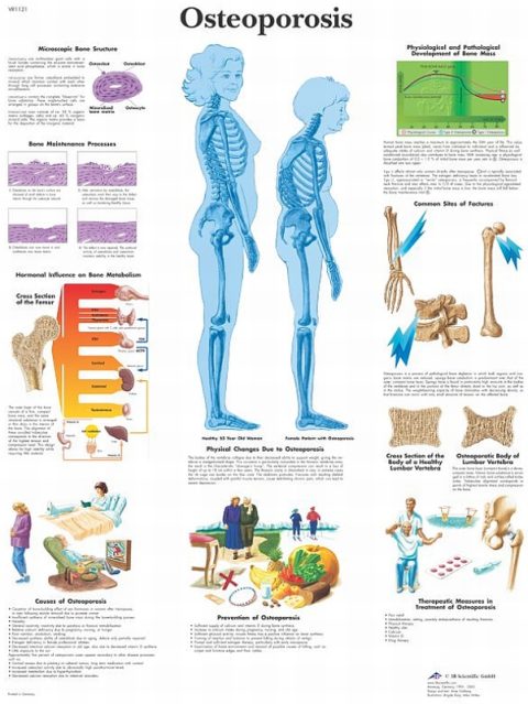 Osteoporosis, gelamineerde wandplaat