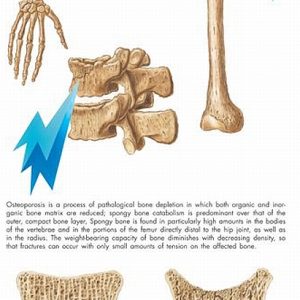 Osteoporosis, papieren wandplaat