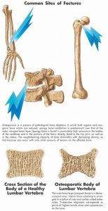 Osteoporosis, gelamineerde wandplaat