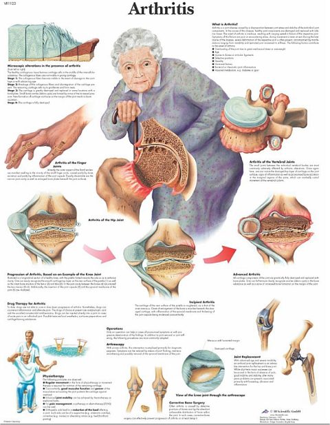 Arthritis, papieren wandplaat