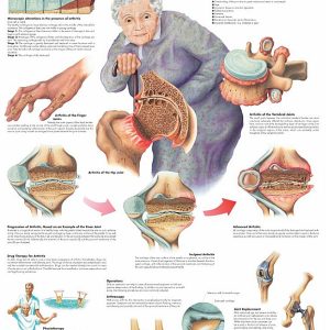 Arthritis, gelamineerde wandplaat