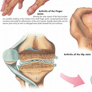 Arthritis, papieren wandplaat