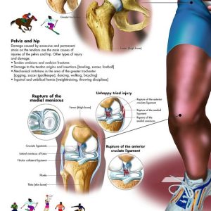 Anatomie Poster Sportblessures, papier