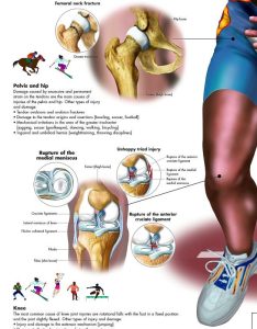Anatomie Poster Sportblessures, gelamineerd