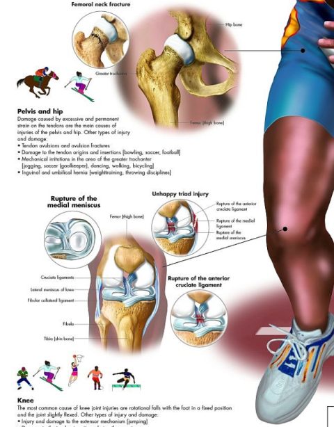 Anatomie Poster Sportblessures, gelamineerd