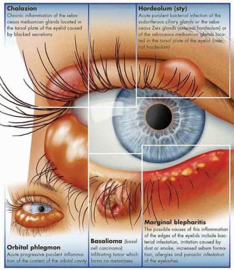 Anatomie Poster Ziektebeelden van het Oog, gelamineerd