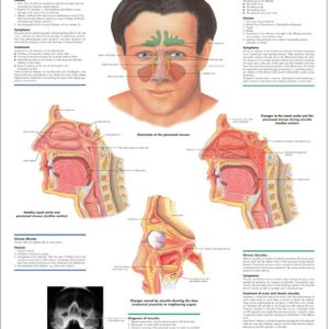 Rhinitis & Sinusitis, gelamineerde wandplaat