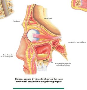Rhinitis & Sinusitis, papieren wandplaat