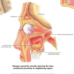 Rhinitis & Sinusitis, papieren wandplaat