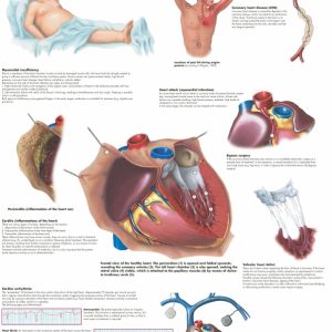 Anatomie Poster Hartziektes, papier