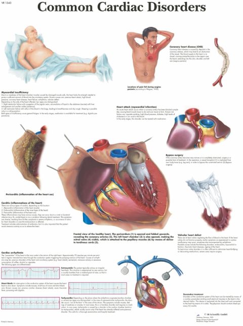 Anatomie Poster Hartziektes, papier