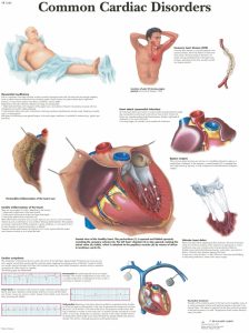 Anatomie Poster Hartziektes, gelamineerd