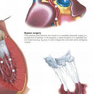 Anatomie Poster Hartziektes, papier