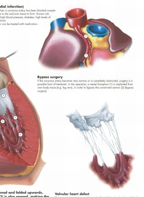Anatomie Poster Hartziektes, gelamineerd