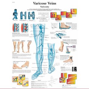 Anatomie Poster Varicose Veins (spat-aderen), gelamineerd