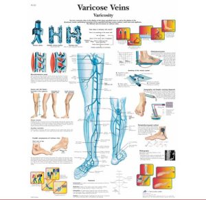 Anatomie Poster Varicose Veins (spat-aderen), papier