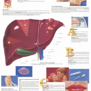 Hepatitis, papieren wandplaat