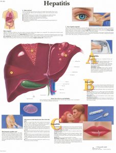 Hepatitis, gelamineerde wandplaat