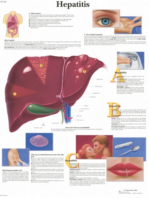 Hepatitis, gelamineerde wandplaat