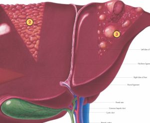 Hepatitis, gelamineerde wandplaat