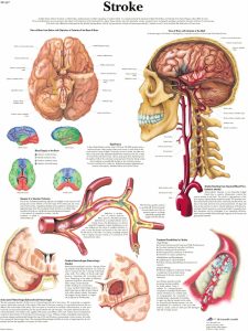 Anatomie Poster Hersenbloeding, papier