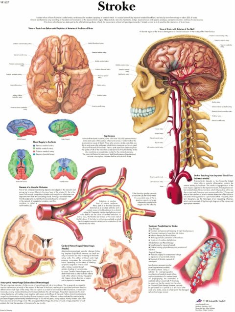 Anatomie Poster Hersenbloeding, papier