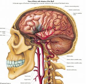Anatomie Poster Hersenbloeding, gelamineerd