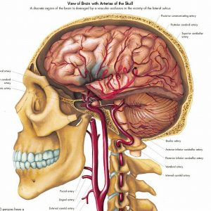 Anatomie Poster Hersenbloeding, gelamineerd