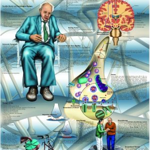 Parkinson, gelamineerde wandplaat