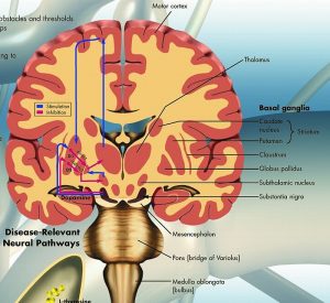 Parkinson, papieren wandplaat