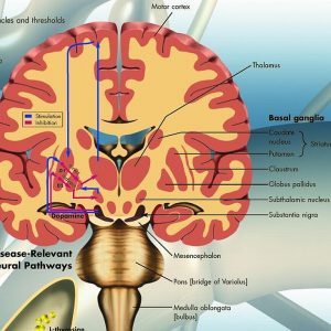 Parkinson, gelamineerde wandplaat