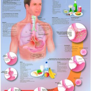Reflux, gelamineerde wandplaat