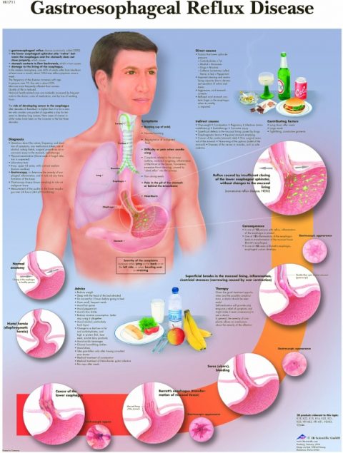 Reflux, gelamineerde wandplaat