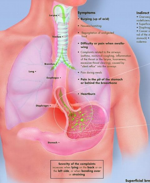 Reflux, gelamineerde wandplaat