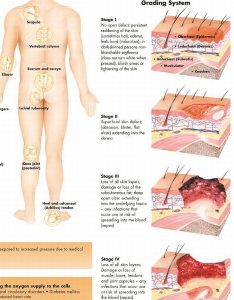 Anatomie Poster Decubitus, gelamineerd