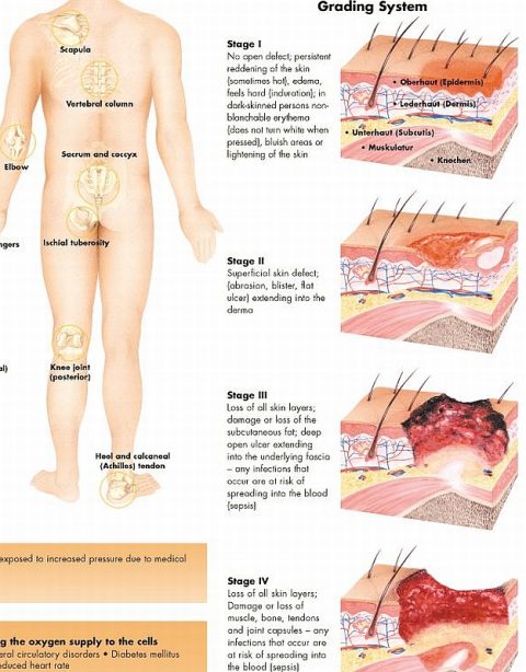 Anatomie Poster Decubitus, gelamineerd