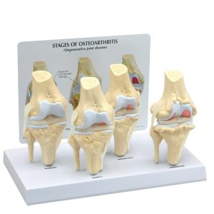 Knie, 4 stadia osteoarthritis
