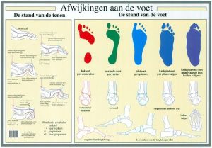 Afwijkingen aan de Voet Poster A2 Nederlands