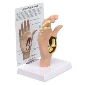 Anatomisch Model Osteoartritis Hand