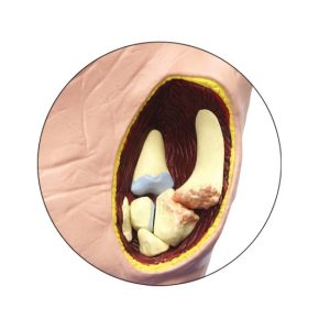 Anatomisch Model Osteoartritis Hand