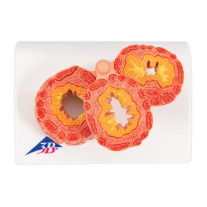 COPD Model