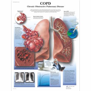 COPD Poster Papier