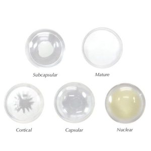 Oogmodel met staar (Cataract)