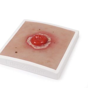 Colostoma met Ontsteking Model