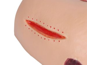 Decubitus Verzorgingsmodel