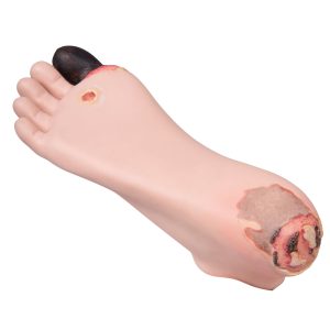 Diabetes Voetmodel